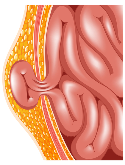 Image-hernie-eventration_full