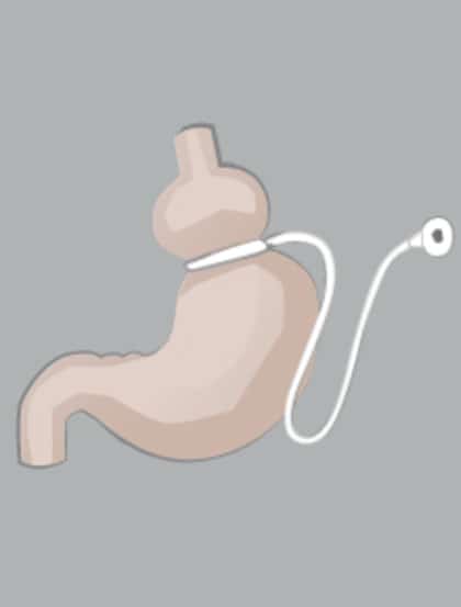 00-anneau-gastrique.jpg_full