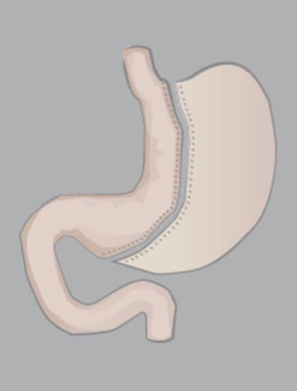 Sleeve-Gastrectomie_full